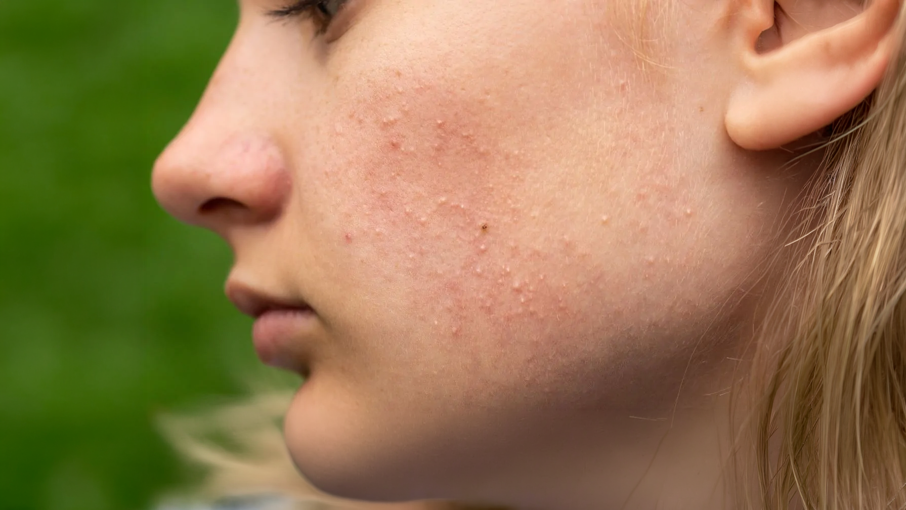 Purging (Cilt Arınması-Kusma Evresi) Nedir? İrritasyon ve Yanlış Reaksiyonlardan Nasıl Ayırt Edilir?